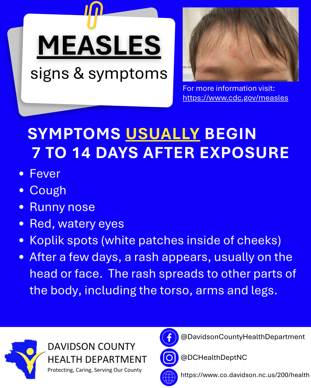 Measles - Signs and Symptoms